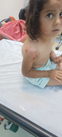 Şanlıurfa'da köpeklerin saldırdığı 4 yaşındaki Eylül, yaralandı